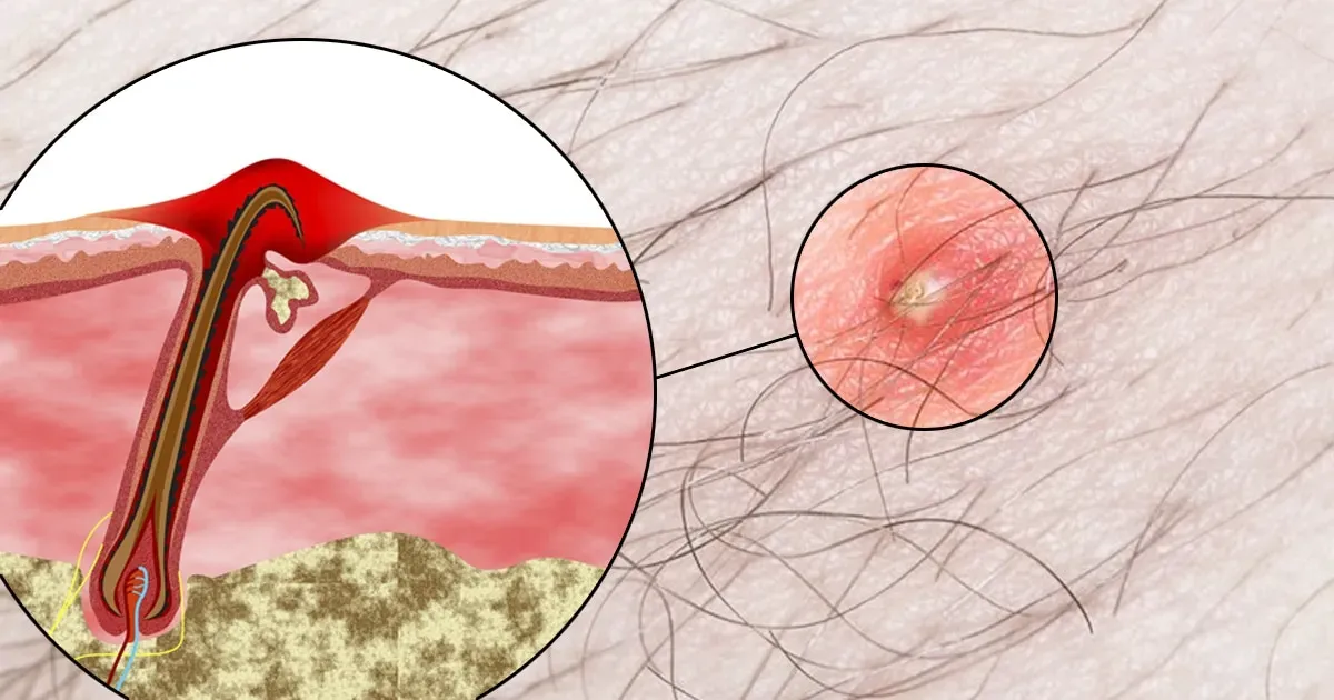 Чистка бикини.