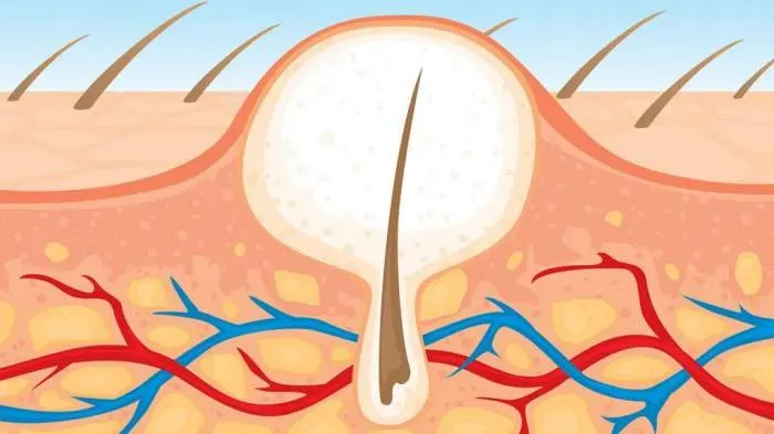 Вросшие волосы. Как бороться?